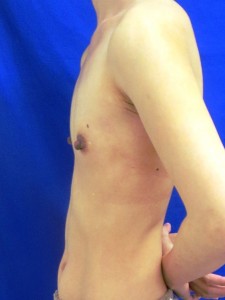 ④術前　左側面